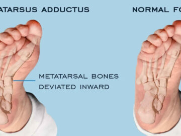 Common bone and Metatarsus Adductus