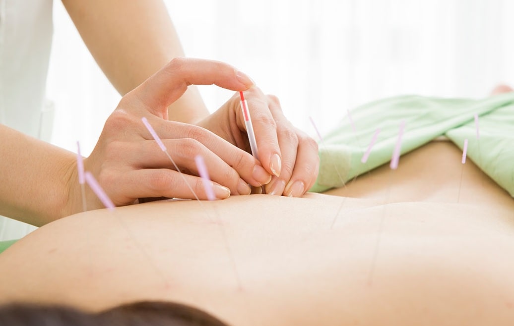 Best Acupuncture services in Calgary - Rhema Gold Physiorehab