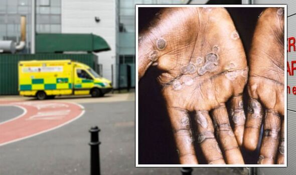 Cases of rare Monkeypox disease reported in the UK, medical authorities on alert