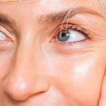 Botox Cosmetic For Crows Feet