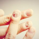 NAIL INFECTIONS
