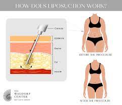 Liposuction Procedures