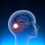 Inserting computer chip inside human brains Neuralink by Elon musk 2022