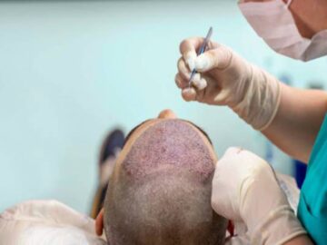 Exploring the Various Methods of Hair Transplantation
