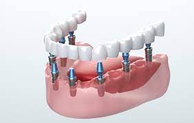 Getting dental implants in Thailand - The Process
