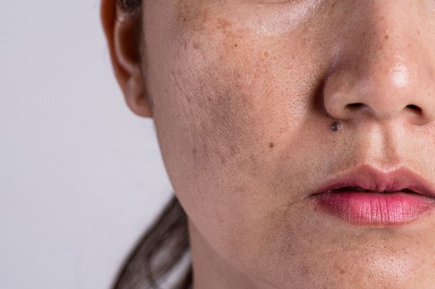 Getting Rid of Hyperpigmentation -What Works, Cost