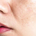 Do This To Get Rid Of Your Hyperpigmentation