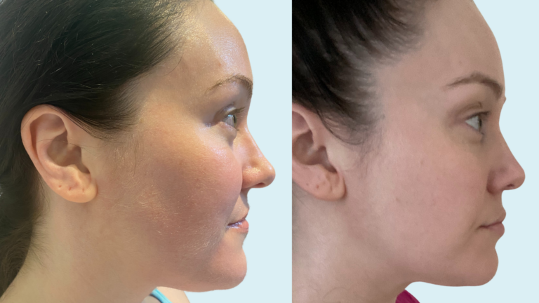 Chin Removal