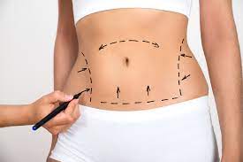 5 Surprising Facts About The Cost Of Liposuction