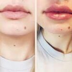 9 Reasons To Get A Lip Filler For More Beautiful Lips