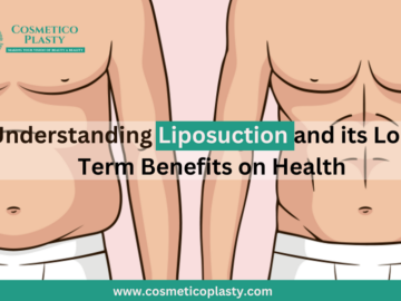 Understanding Liposuction And Its Long-Term Benefits On Health