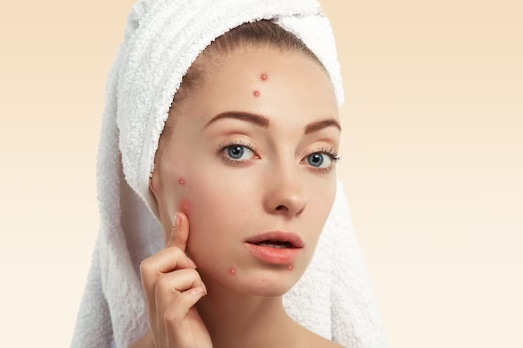 How long does it take for niacinamide to work on acne?