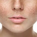 The Cost of Pigmentation Treatment in Mumbai Is Worth The Results