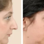 Is rhinoplasty results permanent?
