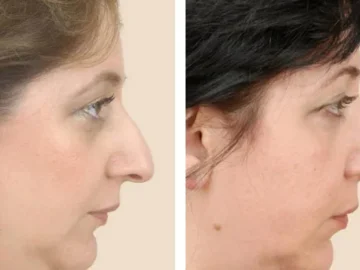 Is rhinoplasty results permanent?