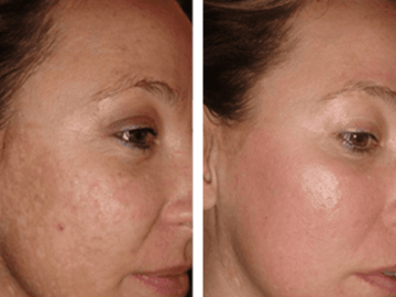 How Laser Treatment Can Reduce Acne Scars