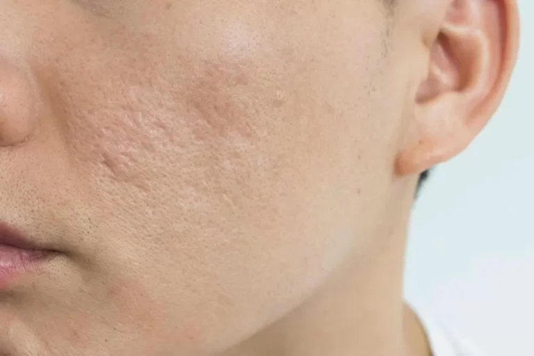 Does Scar Removal Cream Work on Acne Marks?