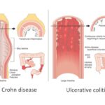 Tips for Living More Comfortably with Ulcerative Colitis (UC)