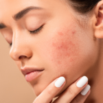 How Acne Laser Treatment Can Help You Achieve Your Skincare Goals
