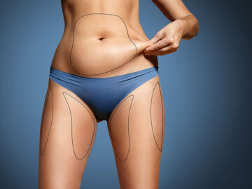 How Long Does Liposuction Result Last For Middle-Aged Women and Men?