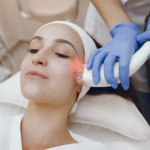 What to Expect from Laser Treatment for Acne Scars?