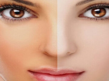 4 Things You Need to Know About Treatment For Skin Whitening
