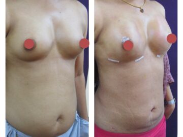breast fat grafting