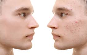Regain Your Confidence With Laser Treatment For Acne Scars