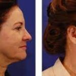 What is Endoscopic Facelift? Our Plastic Surgeon Tells All