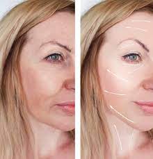 How Much Is The Cost Of an Endoscopic Facelift – Get The Facts Clear