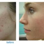 How Well Does Fractional CO2 Laser Work For Acne Scars?