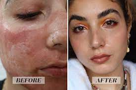 How Many Sessions of Fractional CO2 Are Needed For Acne Scars?