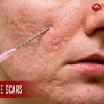 Why Do Dermatologists Prefer PRP Treatment For Acne Scars?