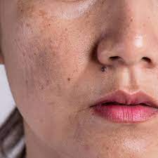 Fade Away Dark Spots - Discover the Best Pigmentation Removal Treatments