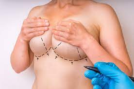 Breast Lift Surgery - Tips for a Fast and Successful Recovery