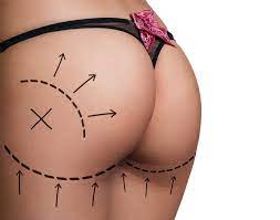 How long do butt implants last? – We Asked A Plastic Surgeon