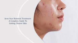 The Benefits of Acne Laser Treatment - Clearer Skin With Minimal Scarring