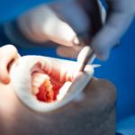 The Major Problem in Dental Implants