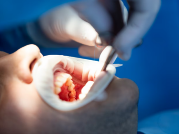 The Major Problem in Dental Implants