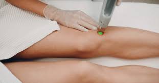 How painful is Full Body Laser Hair Removal?