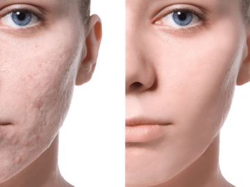 Benefits of Laser Treatment For Acne Scars