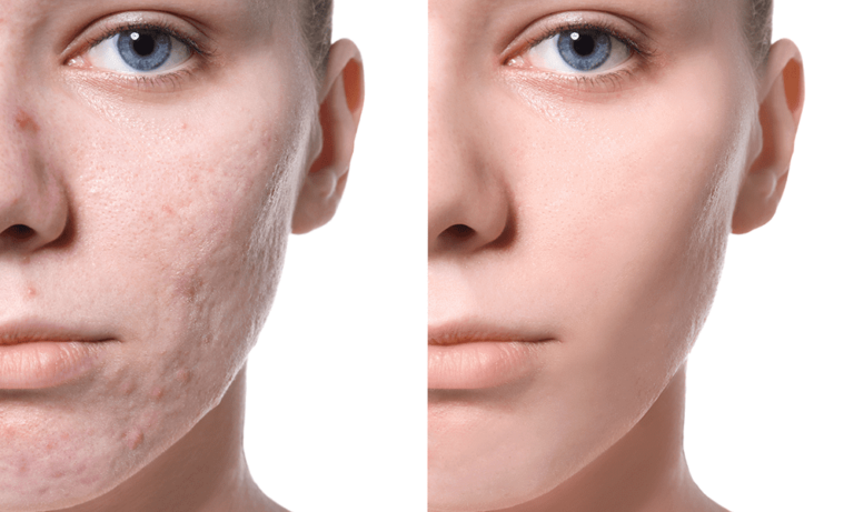 Is Acne Laser Treatment Right for You?