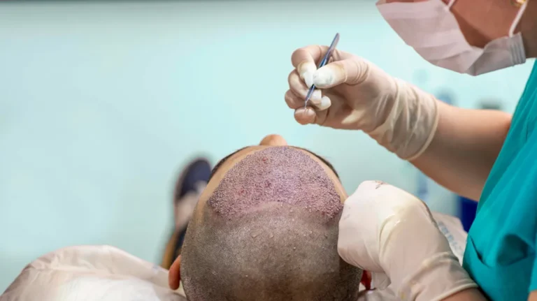 What to Expect from Multiple Hair Transplant Sessions: A Comprehensive Guide