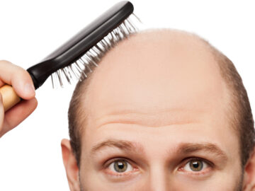 Getting Bald? Here Are The Types of Hair Transplant You Can Get