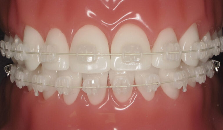 Straighten Your Smile with 6 Month Smiles: A Fast and Effective Orthodontic Solution