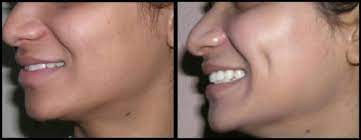 Dimple Creation Surgery