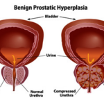 Hyperplasia Symptoms: Understanding and Managing the Condition