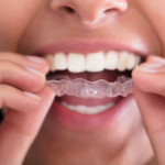 Invisalign Cost in Los Angeles