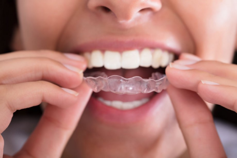 Invisalign Cost in Los Angeles