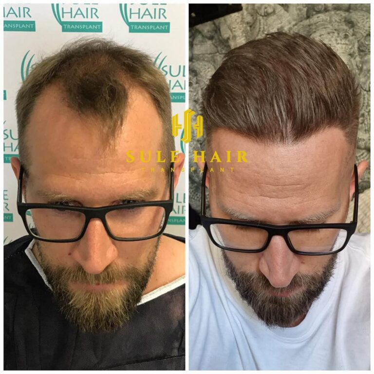 Hair Transplantation Journey: Before and After Photos at Sule Clinic